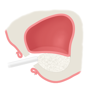 Lateral Window Sinus Augmentation